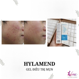 GEL TRỊ MỤN HYLAMEND